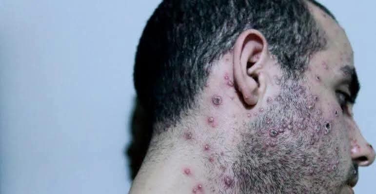CONFIRMAN EN SAN JUAN UN CASO DE MPOX